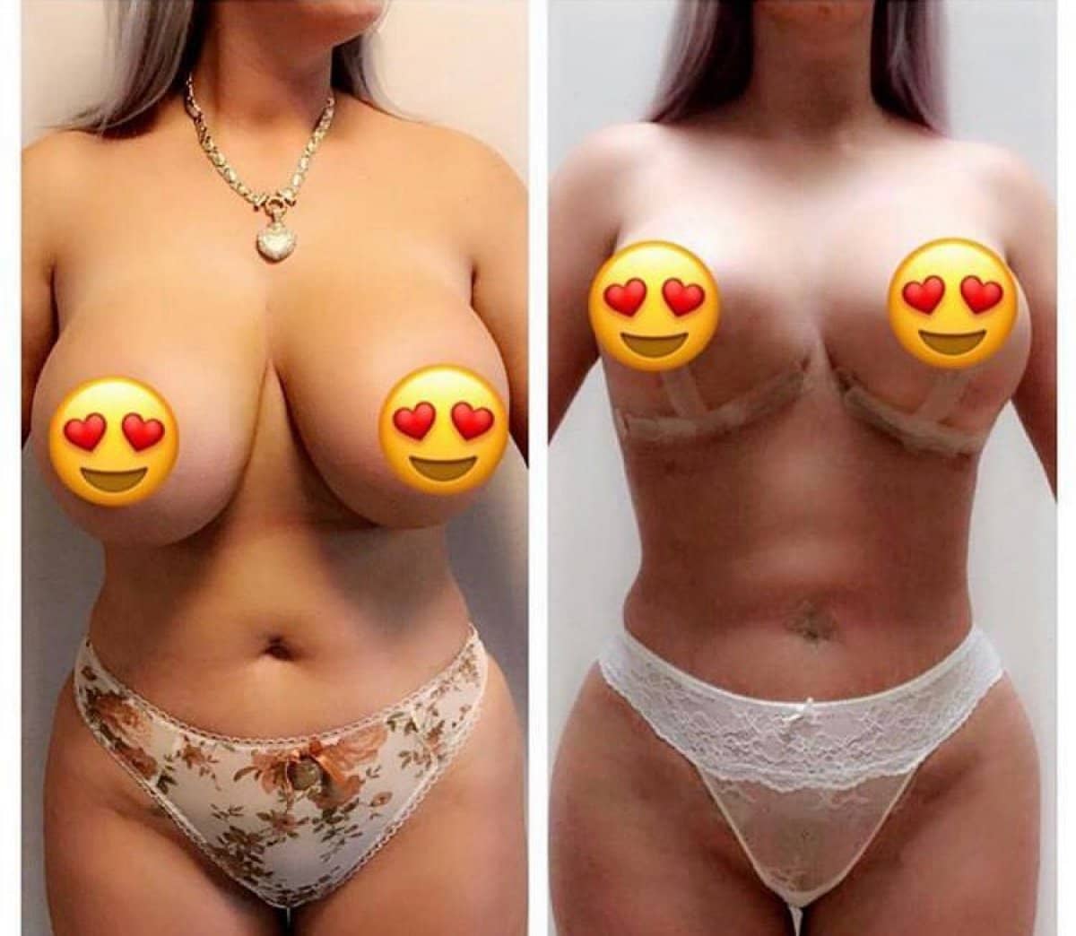 Case 16440 - breast reduction