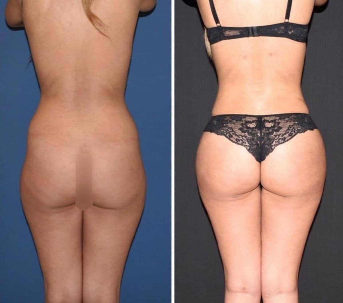 Case 16443 - Brazilian Butt Lift