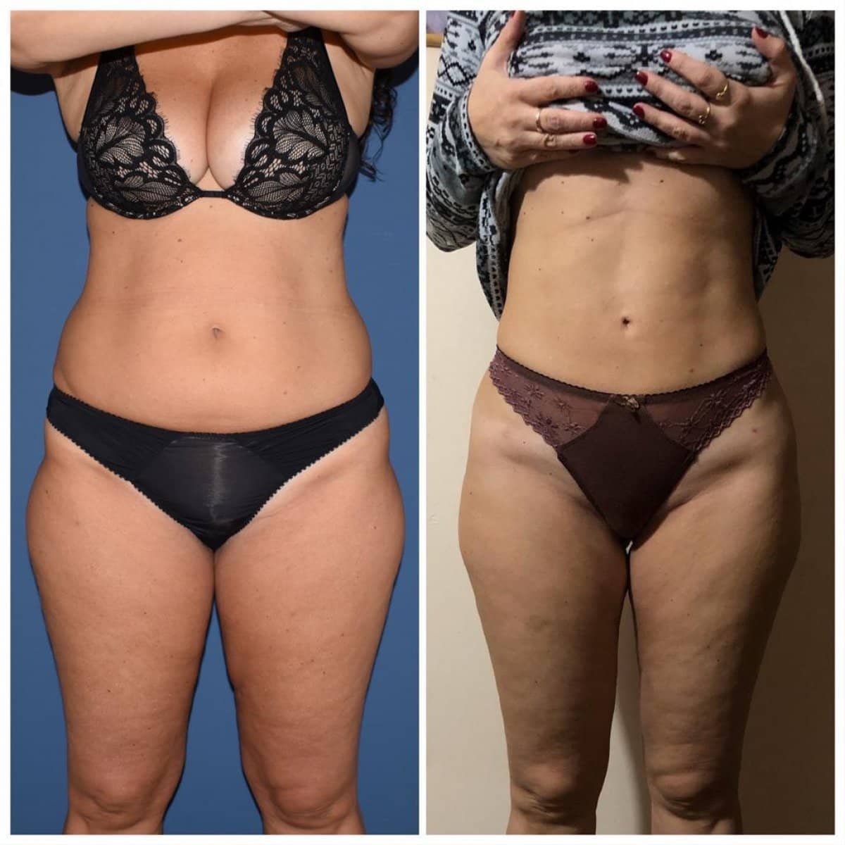Case 16446 - liposuction