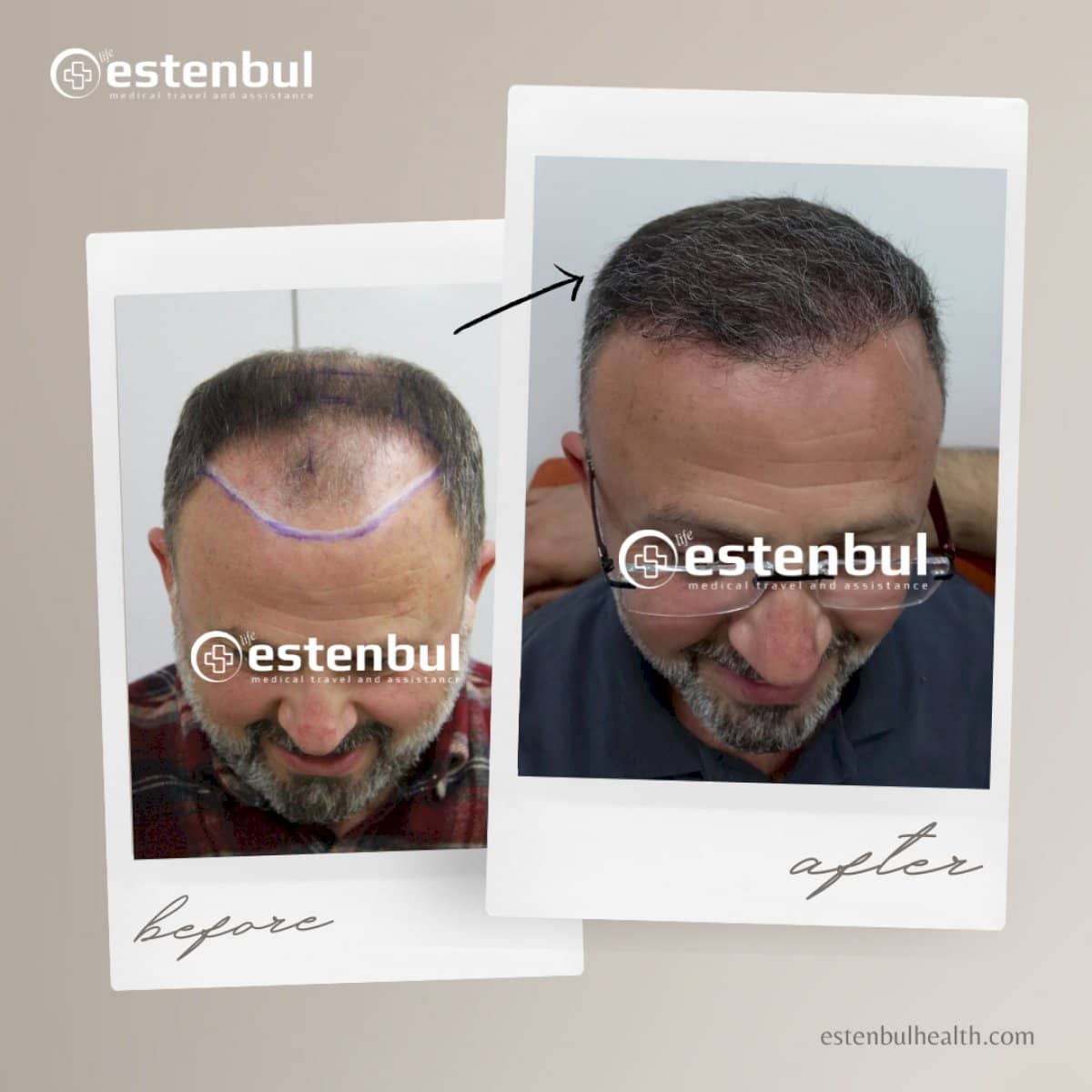 Case 16457 - FUE hair transplant