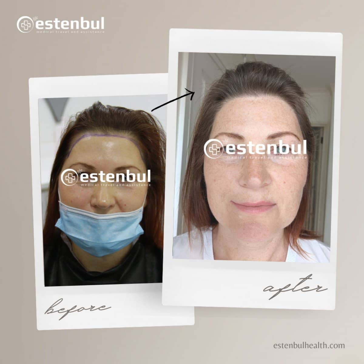 Case 16460 - FUE hair transplant