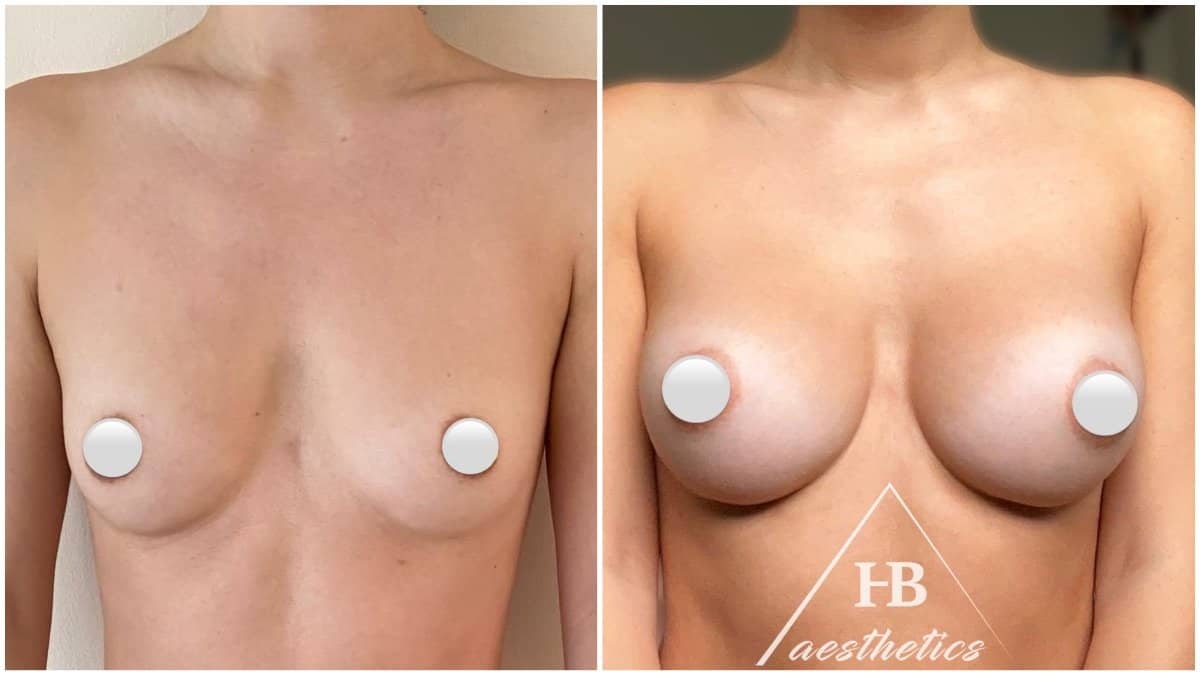 Case 16494 - breast augmentation