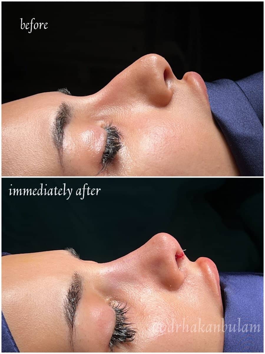 Case 16498 - rhinoplasty