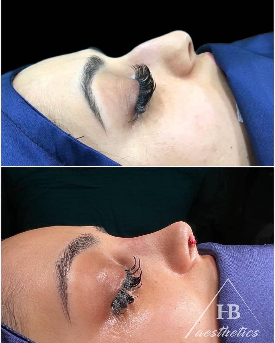 Case 16499 - rhinoplasty