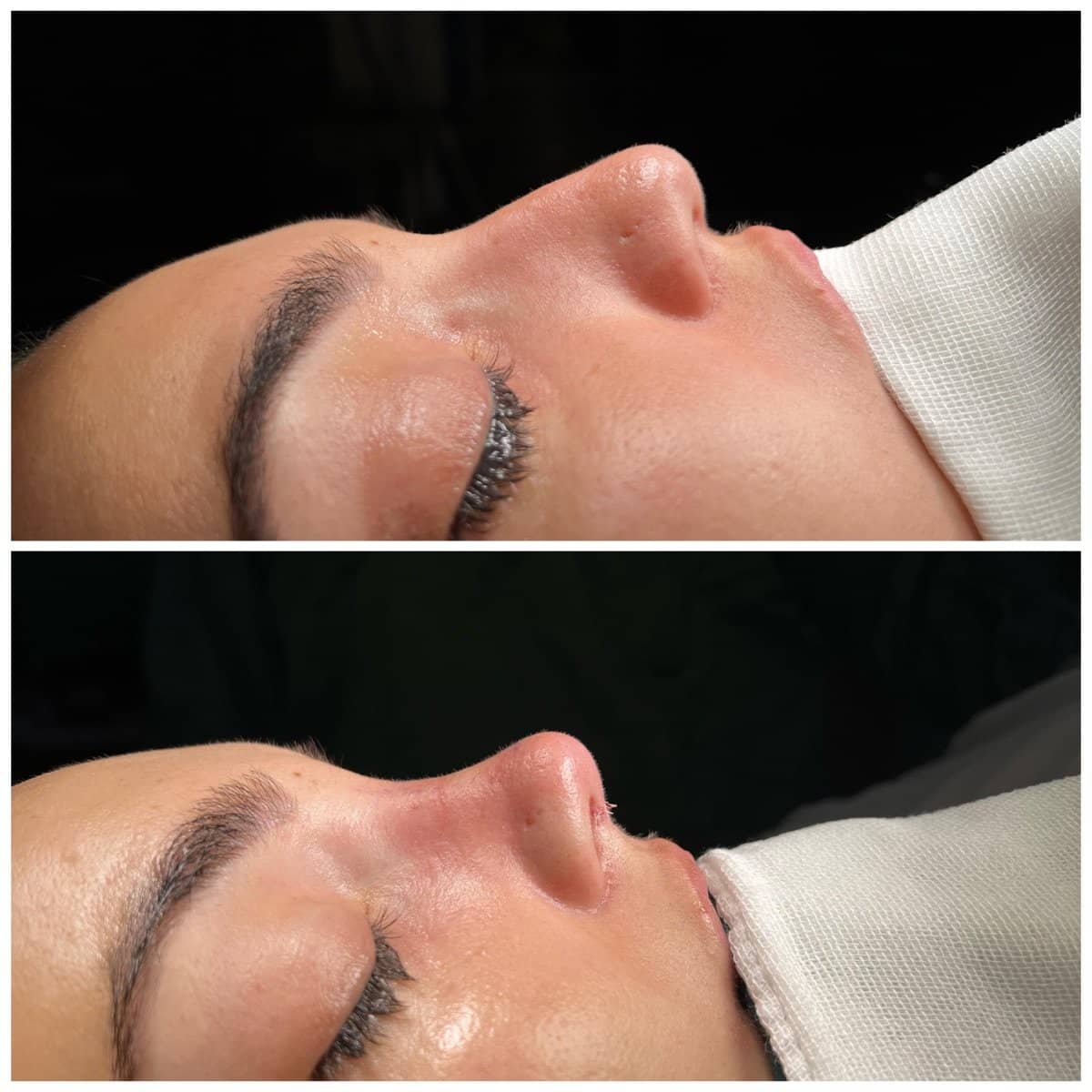 Case 16501 - rhinoplasty