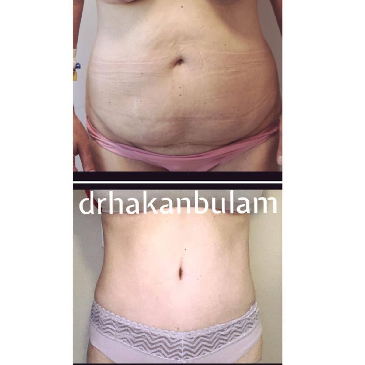Case 16505 - tummy tuck and liposuction