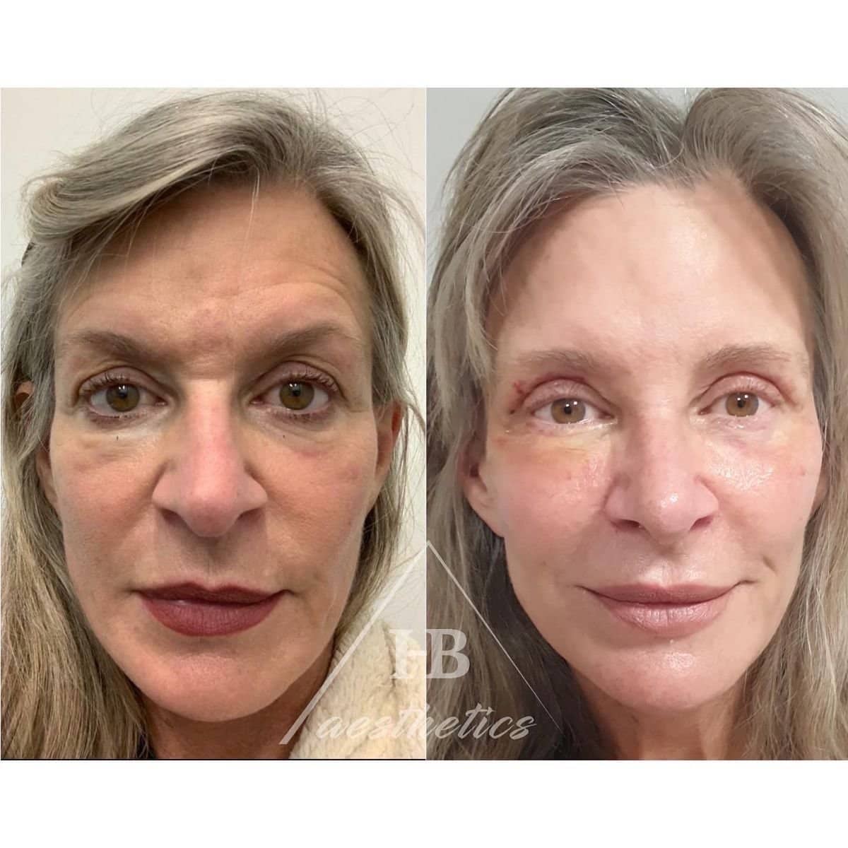 Case 16509 - blepharoplasty