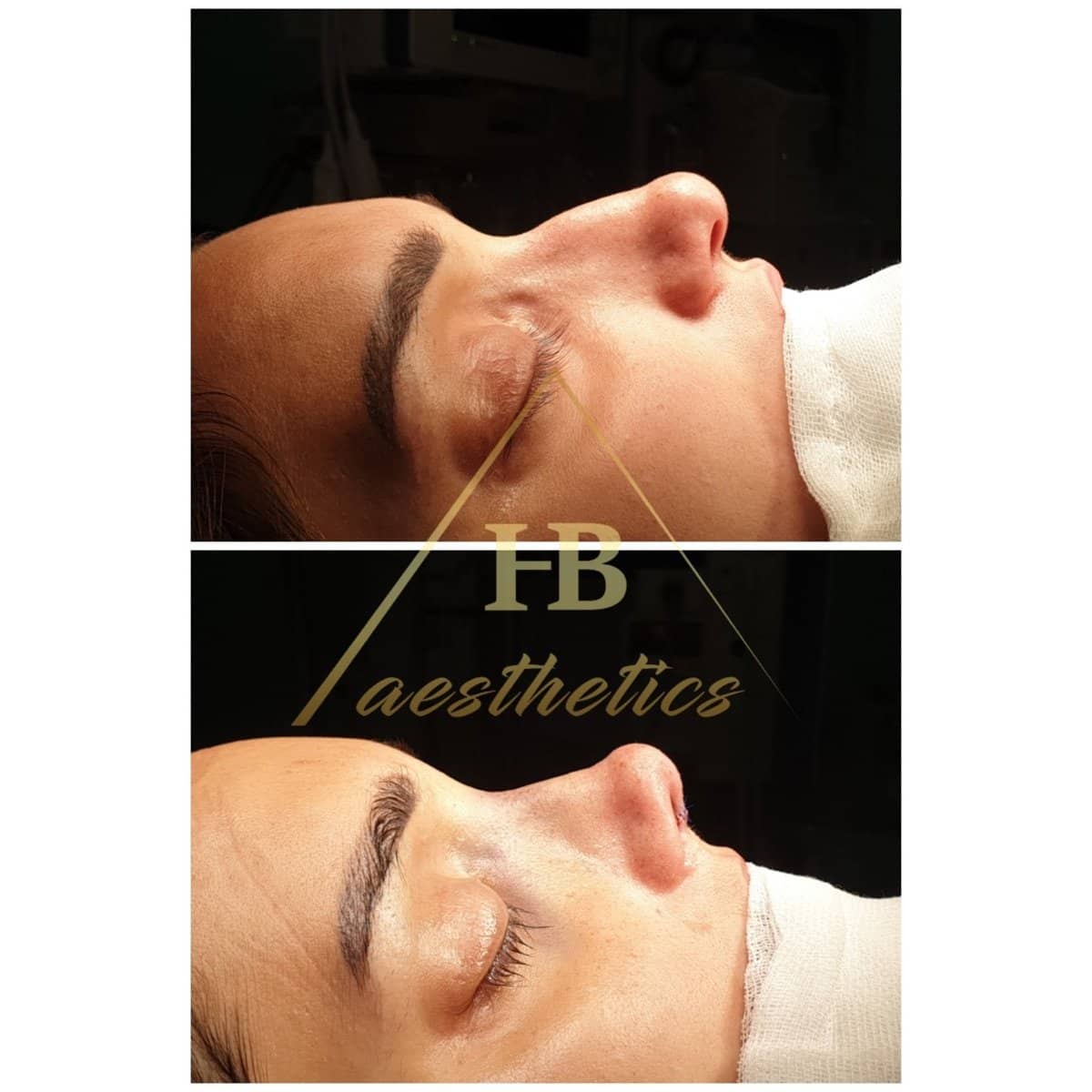 Case 16511 - rhinoplasty