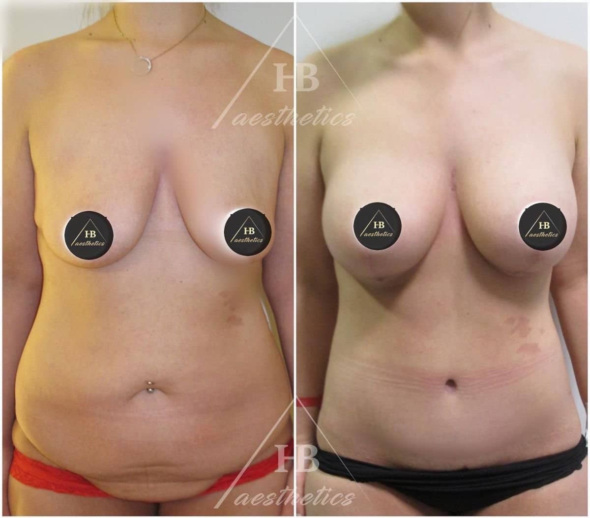 Case 16512 - tummy tuck and liposuction