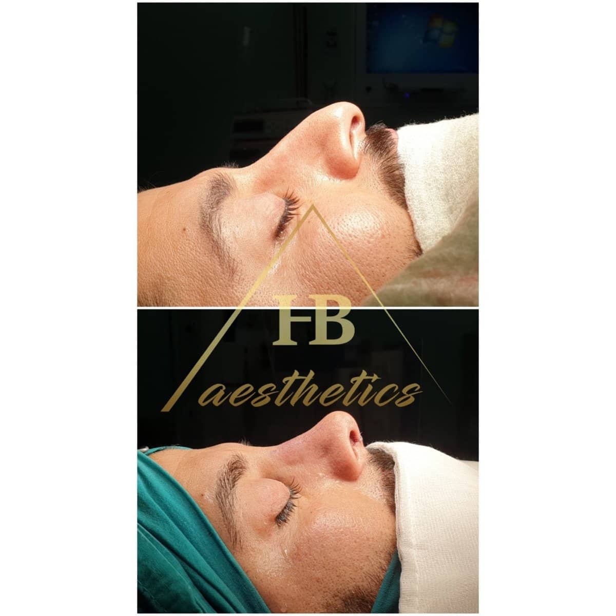 Case 16515 - rhinoplasty