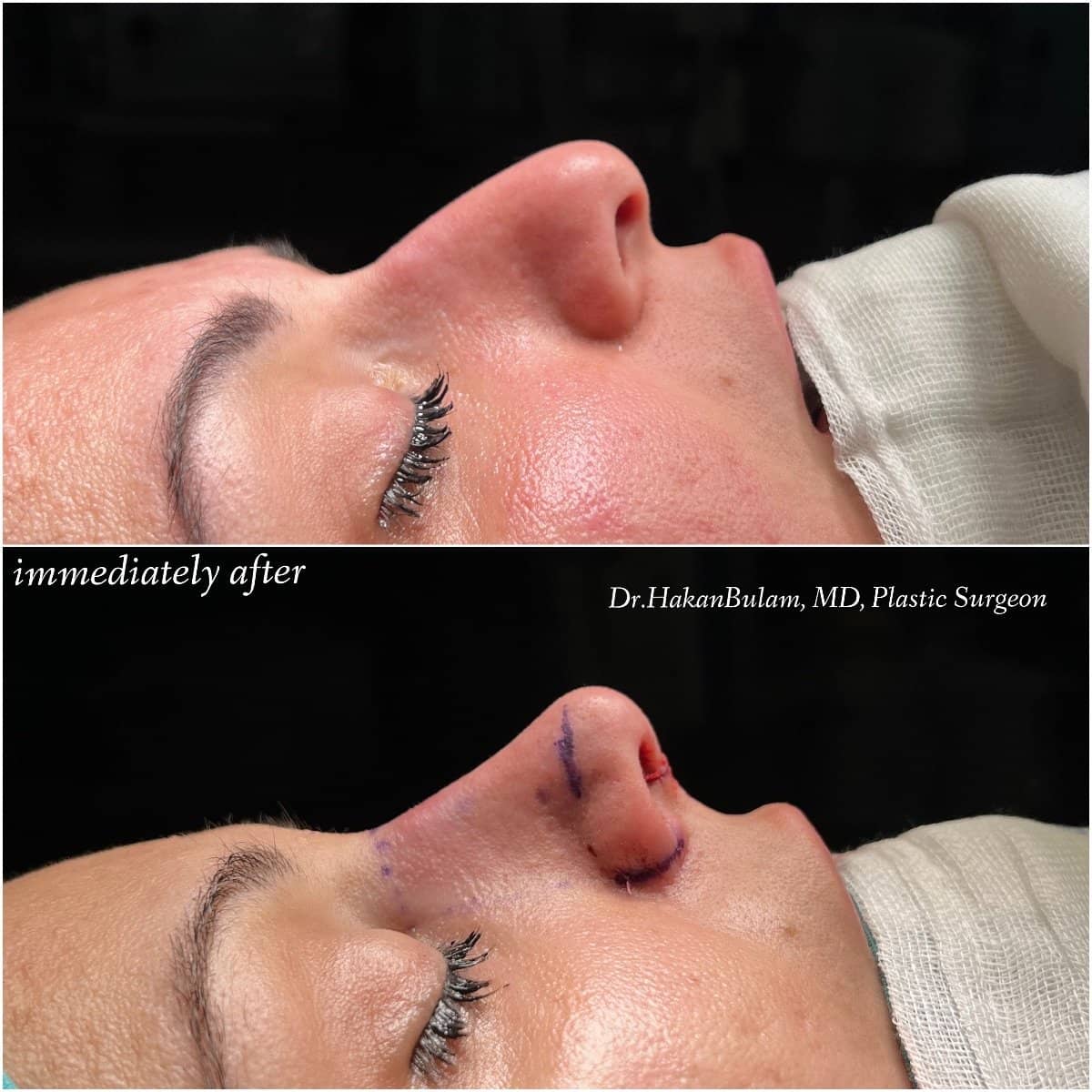 Case 16516 - rhinoplasty