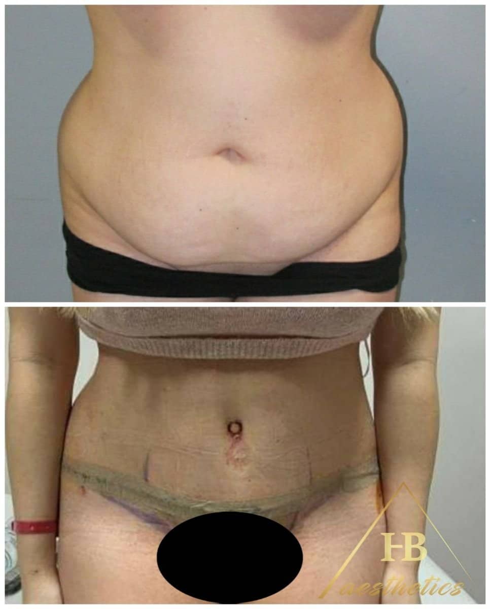 Case 16522 - tummy tuck and liposuction