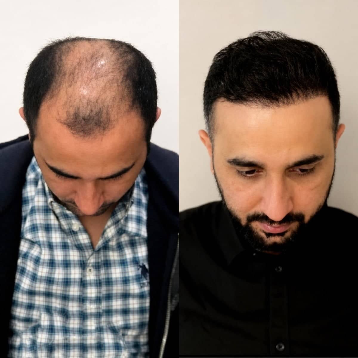 Case 16535 - hair transplant