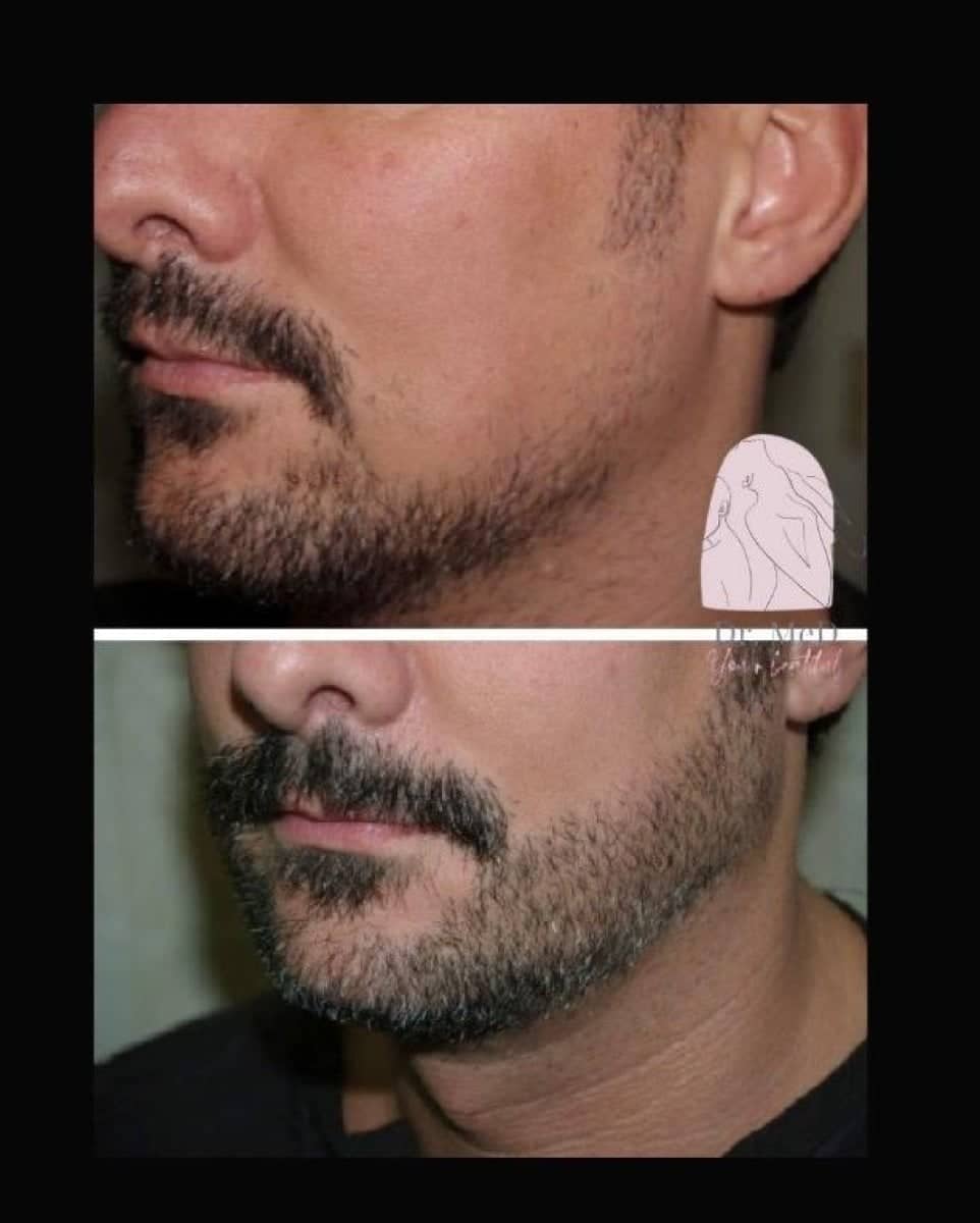 Case 16536 - beard transplant