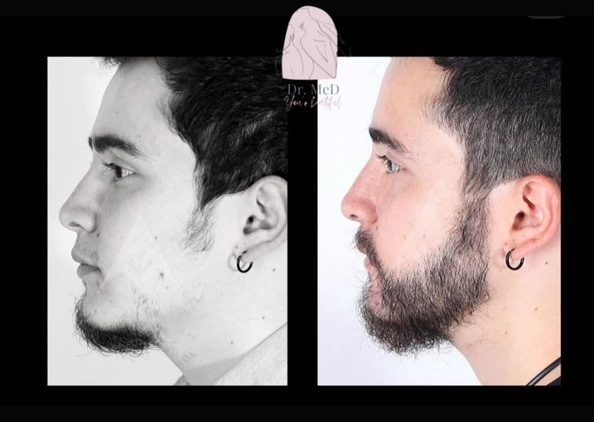 Case 16537 - beard transplant