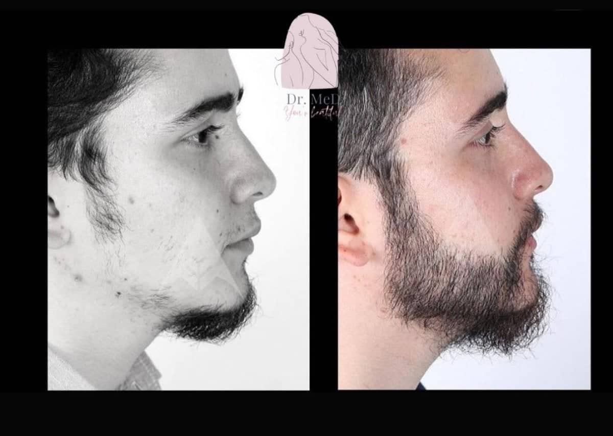 Case 16538 - beard transplant