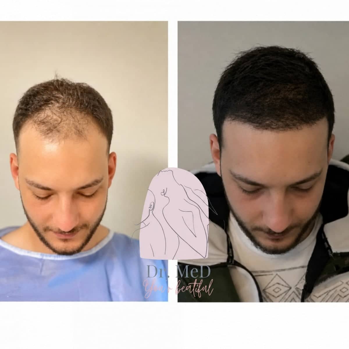 Case 16540 - hair transplant