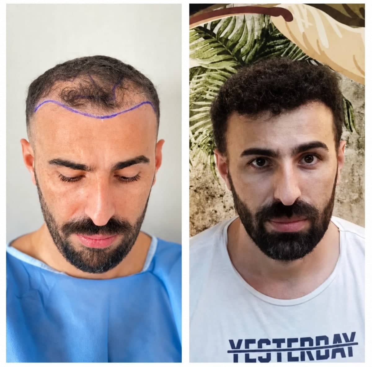 Case 16541 - hair transplant