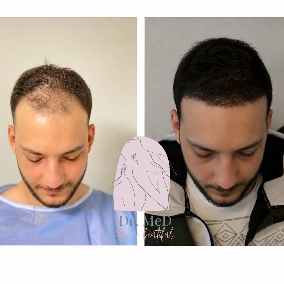 Case 16542 - FUE hair transplant