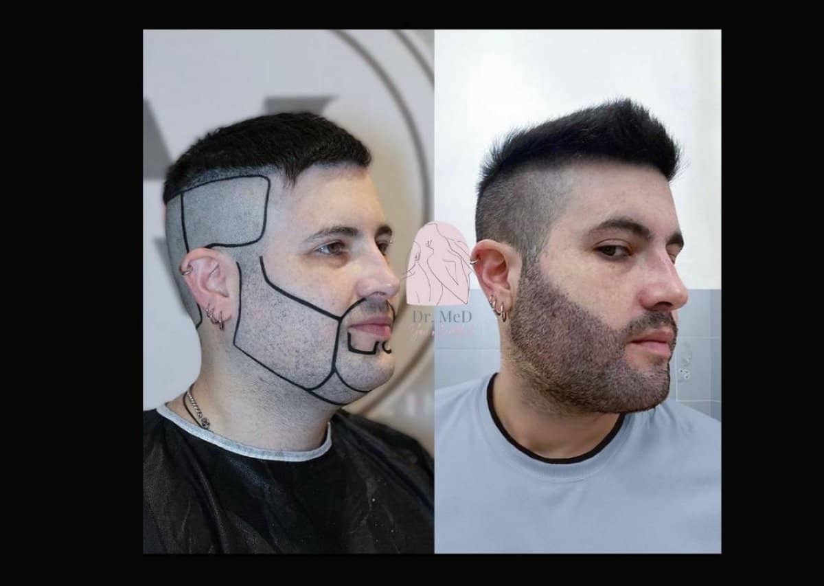 Case 16543 - beard transplant