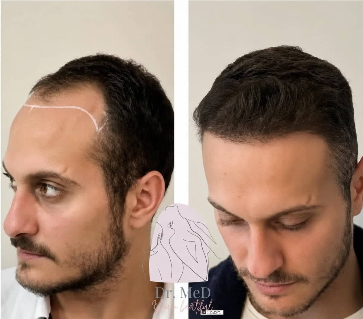 Case 16544 - hair transplant