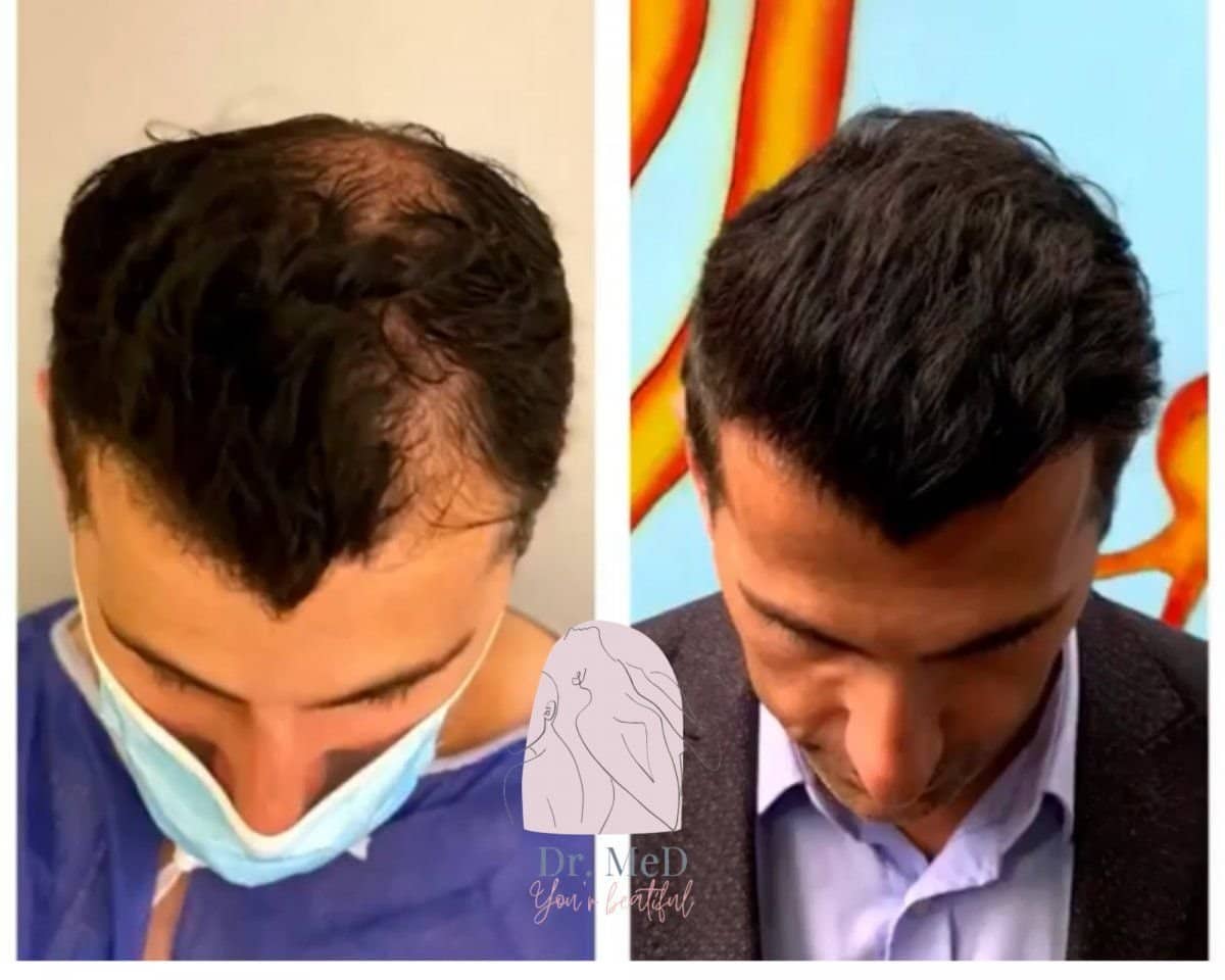 Case 16546 - hair transplant