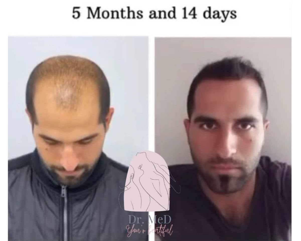 Case 16547 - FUE hair transplant