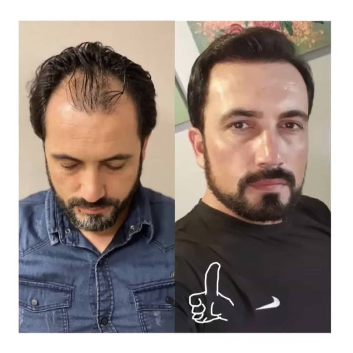 Case 16548 - hair transplant