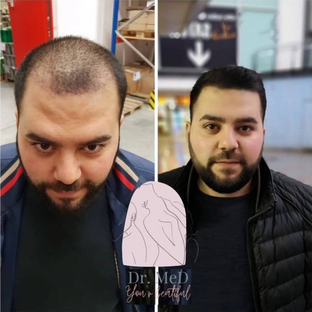 Case 16550 - hair transplant