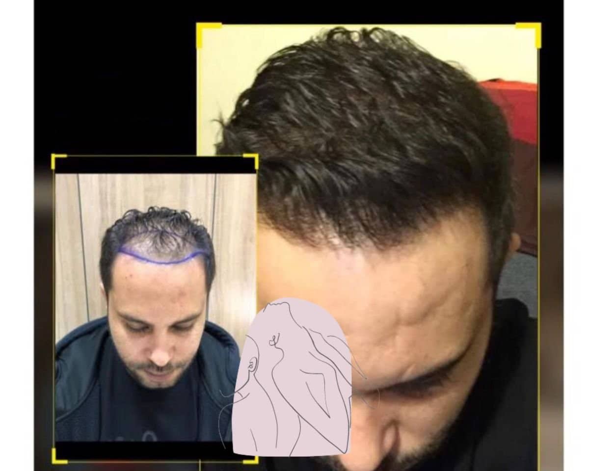 Case 16552 - hair transplant