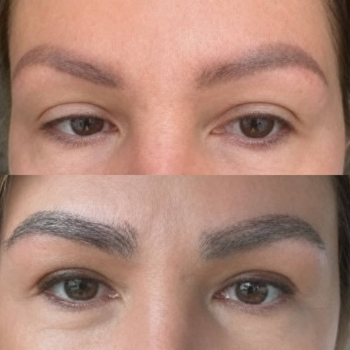 Case 16553 - eyebrow transplantation