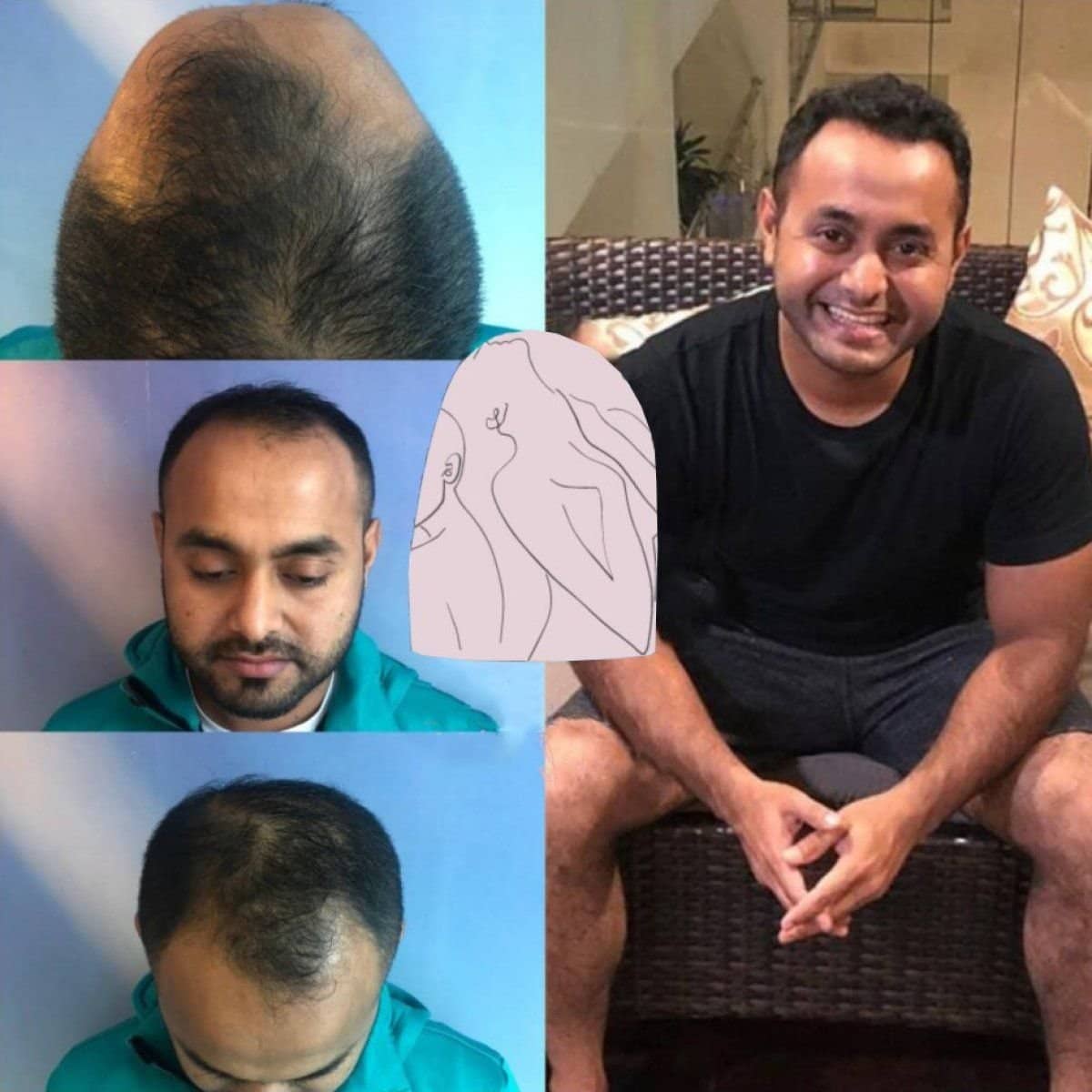 Case 16555 - hair transplant
