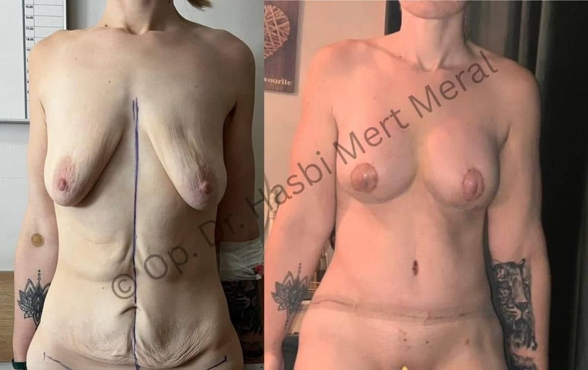 Case 16707 - breast augmentation and body contouring