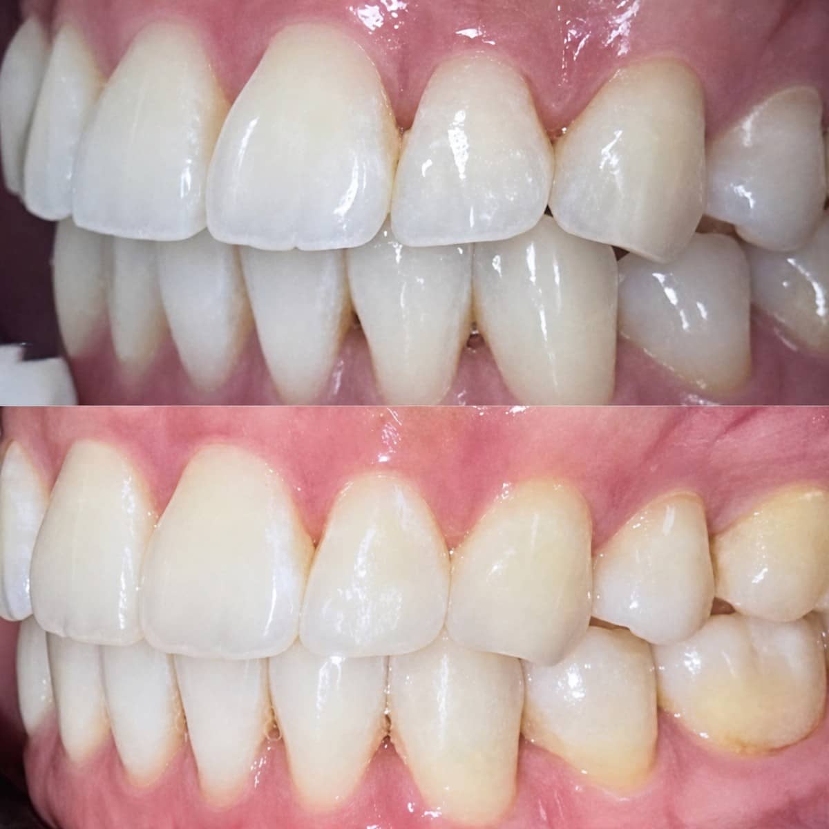 Case 16717 - Invisalign