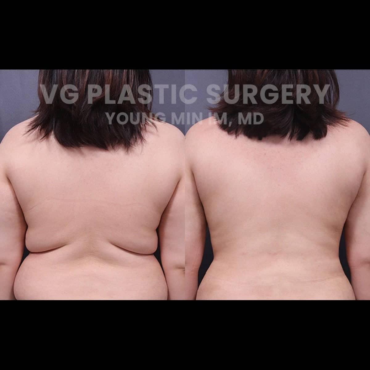 Case 16740 - 360 liposuction