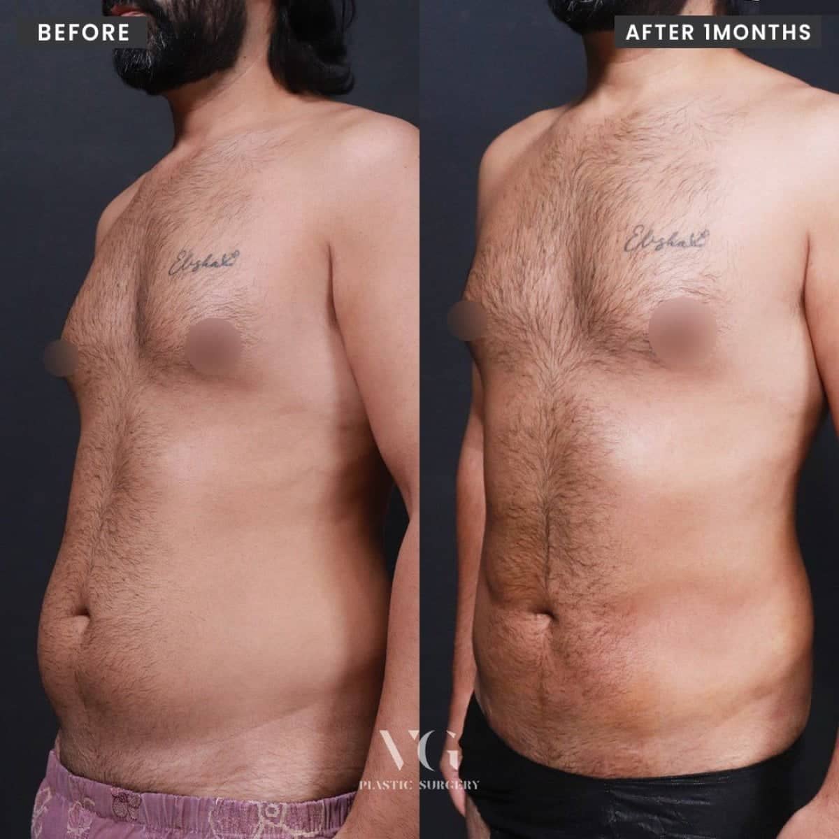 Case 16741 - 360 liposuction