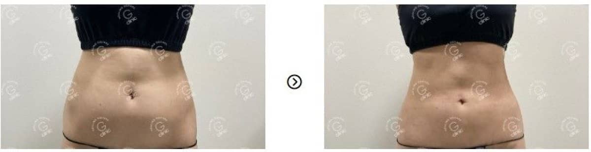 Case 16762 - liposuction