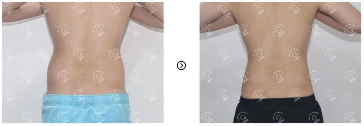 Case 16763 - liposuction