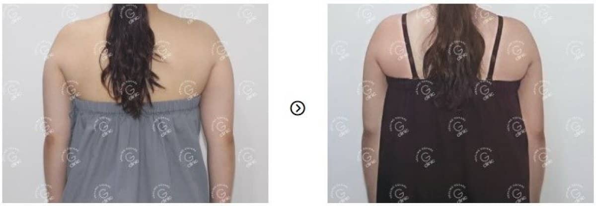 Case 16765 - liposuction