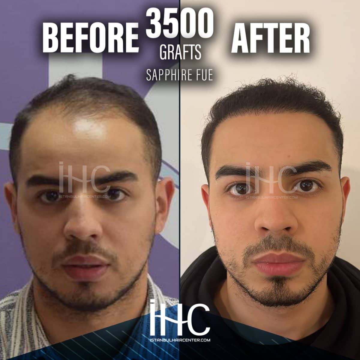 Case 16807 - 3500 grafts Sapphire FUE hair transplant