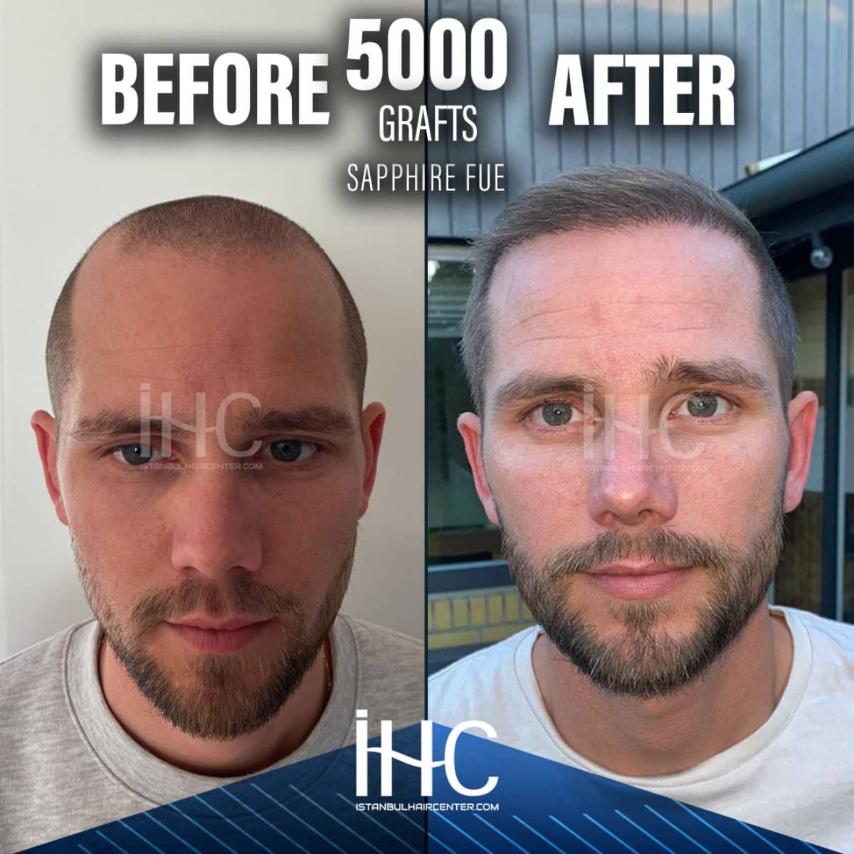 Case 16808 - 5000 grafts Sapphire FUE hair transplant