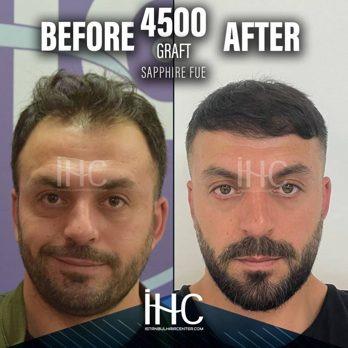 Case 16809 - result of 4500 graft Sapphire FUE hair transplant