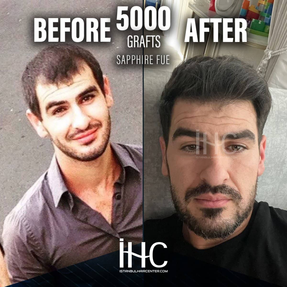 Case 16815 - result of 5000 grafts Sapphire FUE hair transplant
