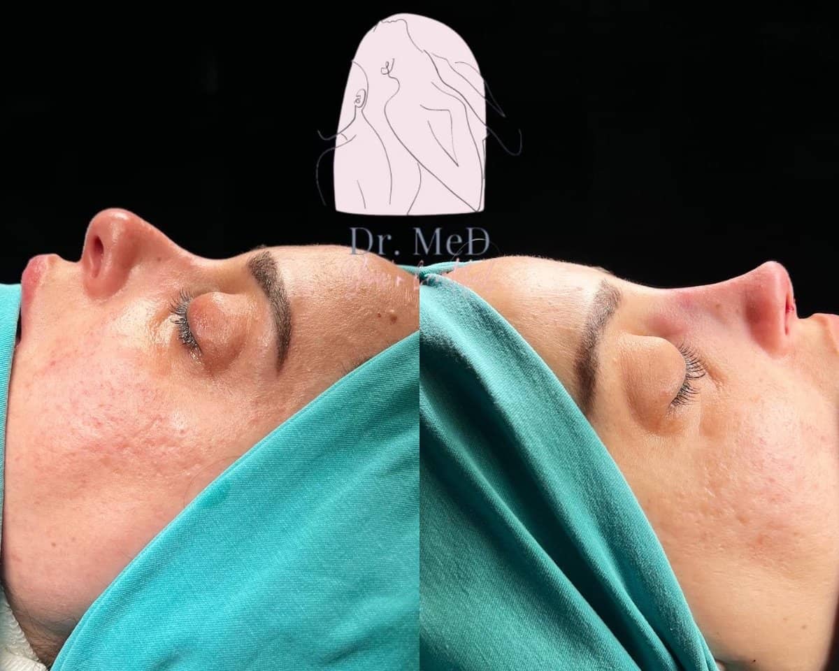 Case 16824 - rhinoplasty