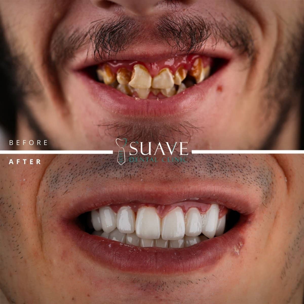 Case 16884 - root canal treatment