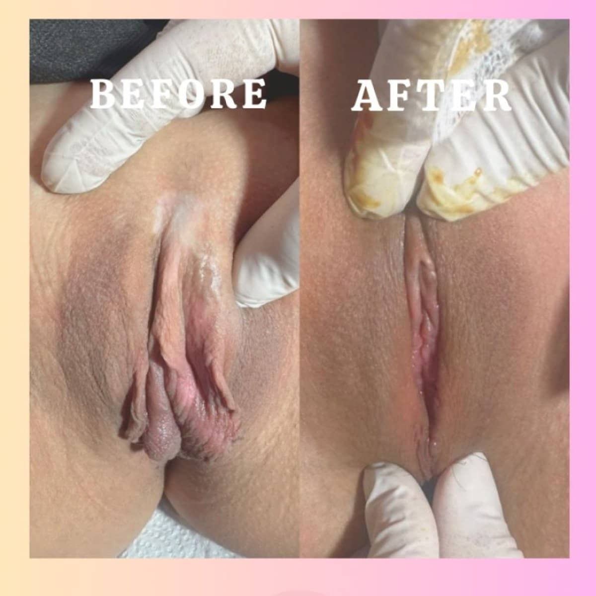 Case 16969 - labiaplasty