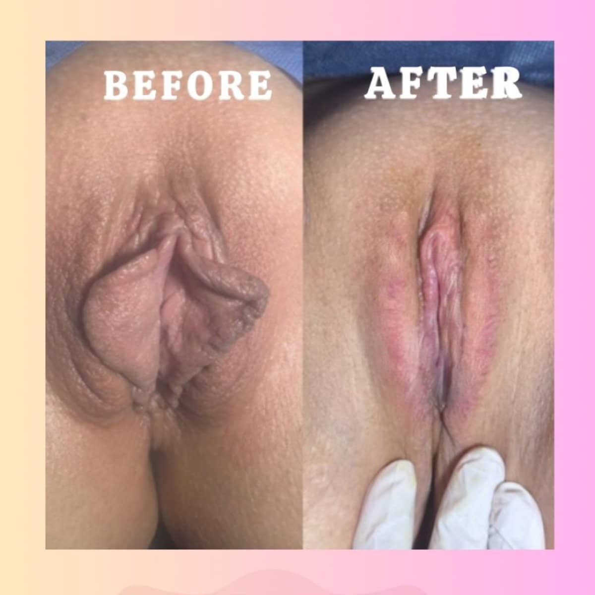 Case 16970 - labiaplasty