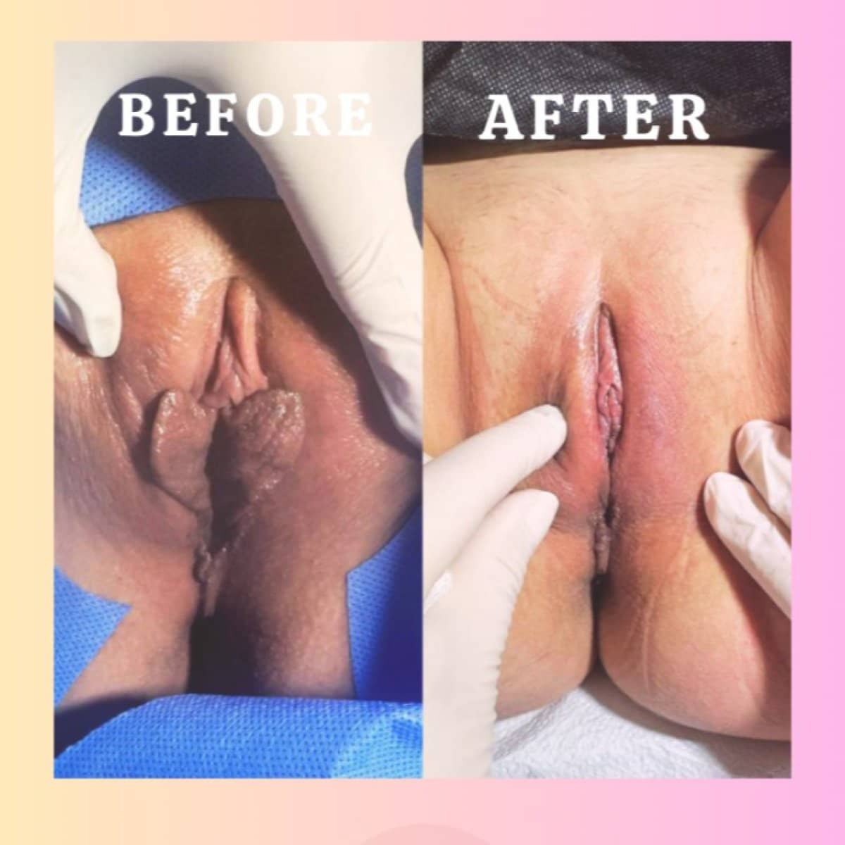 Case 16971 - vaginoplasty