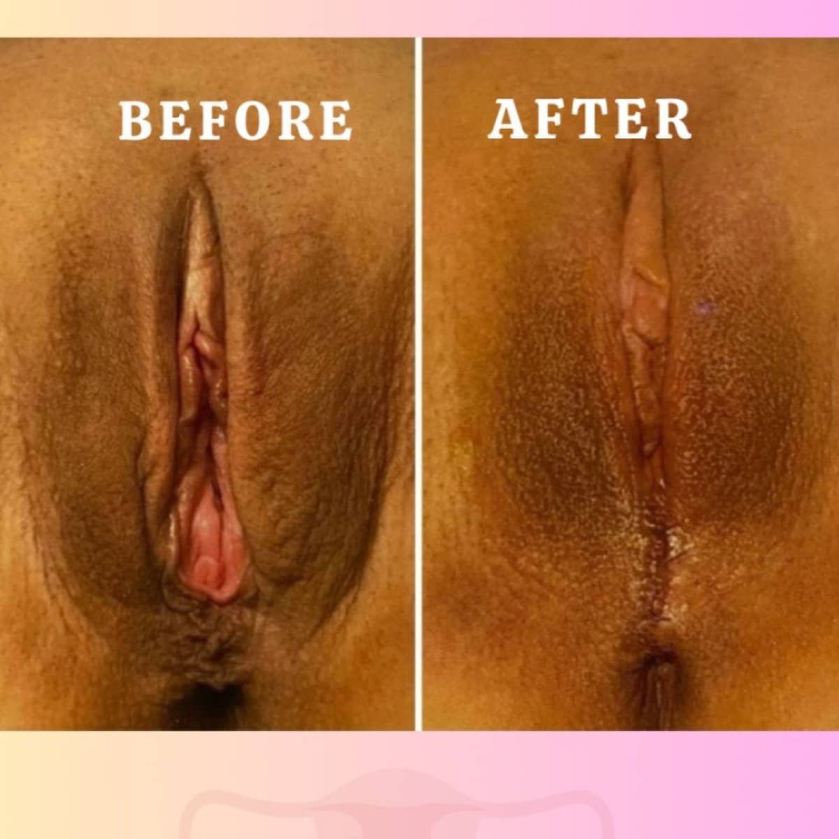 Case 16973 - vaginoplasty