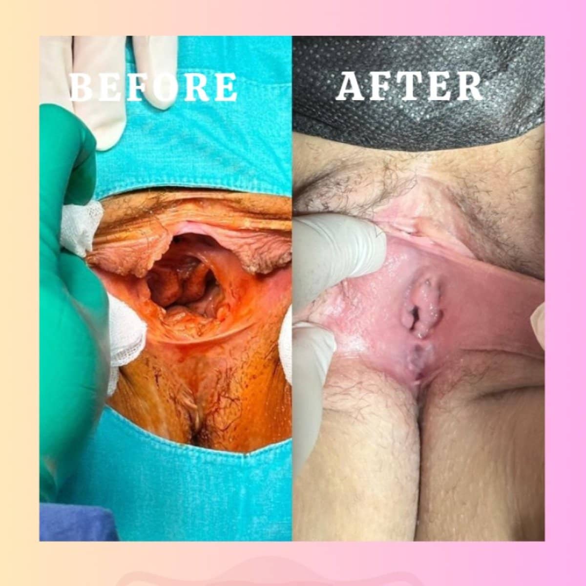 Case 16976 - vaginoplasty
